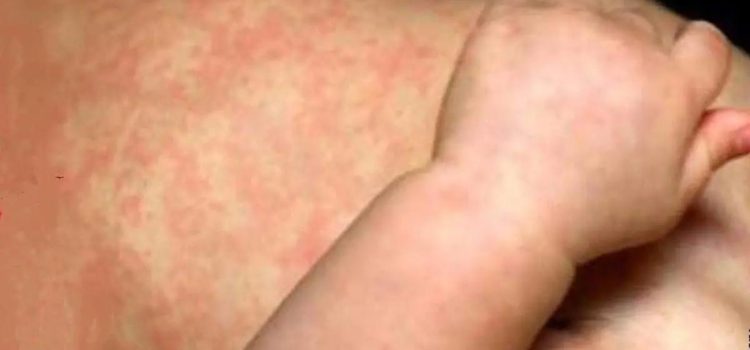 Aumenta a más de 2 mil 700 contagios de sarampión en Chihuahua