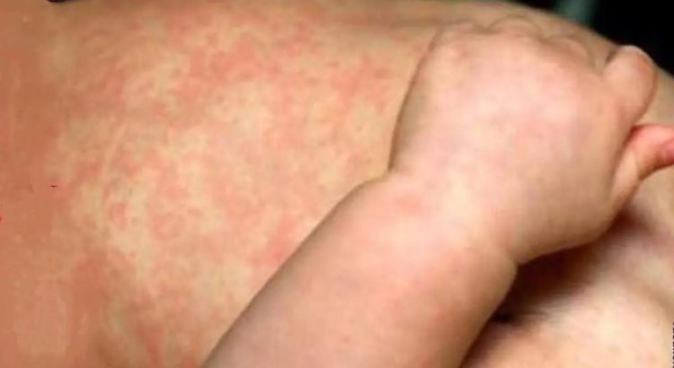 Aumenta a más de 2 mil 700 contagios de sarampión en Chihuahua