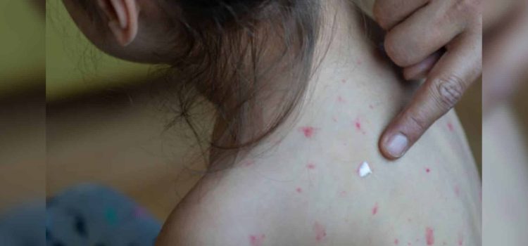 Muere niña por sarampión en Chihuahua: van cuatro fallecidos en el estado