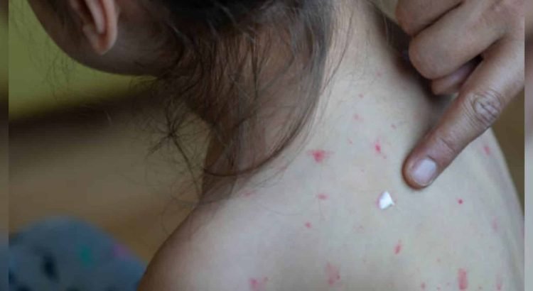 Muere niña por sarampión en Chihuahua: van cuatro fallecidos en el estado
