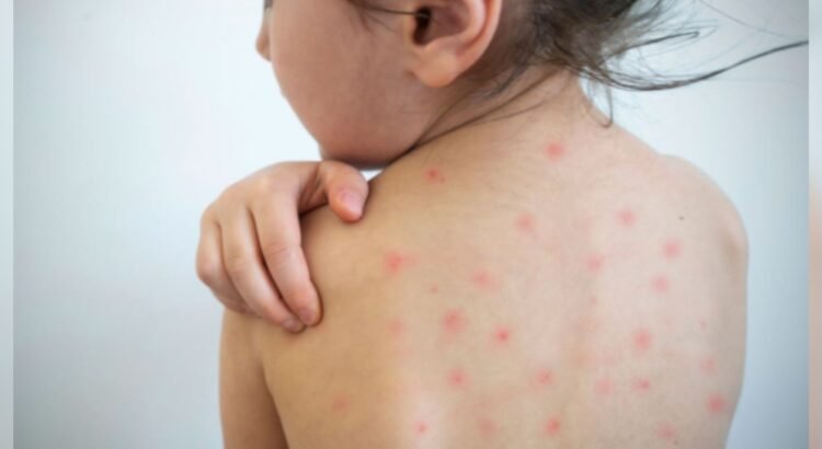 Van 4 mil 133 contagios de sarampión registrados en el estado de Chihuahua; hay 10 personas hospitalizadas